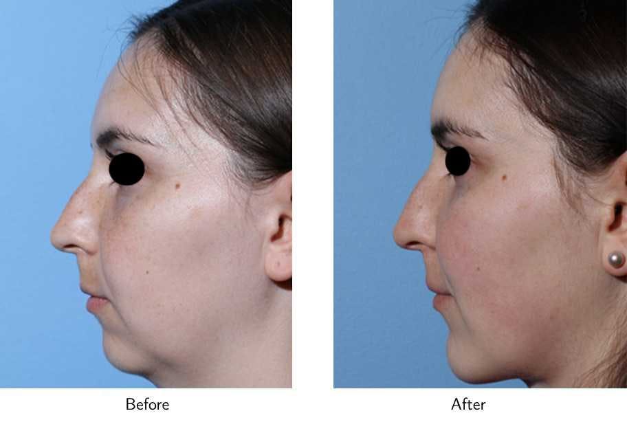 Chin Augmentation Before & After Gallery - Patient 64081169 - Image 2