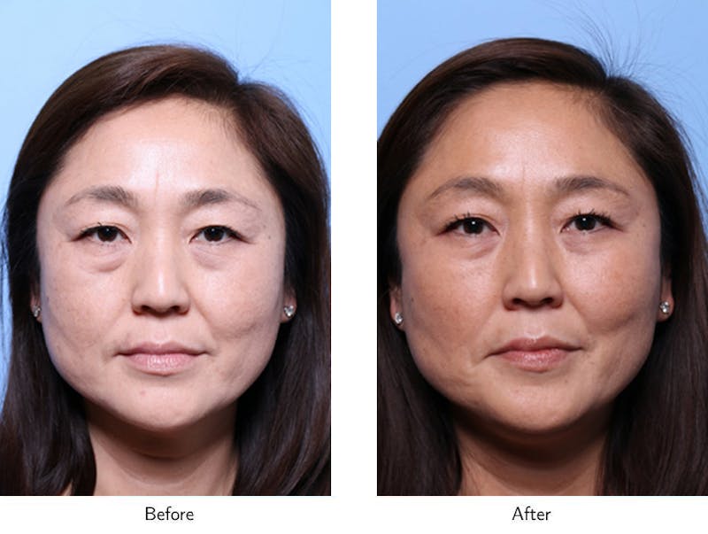 Non-Surgical Facelift Before & After Gallery - Patient 64081172 - Image 1