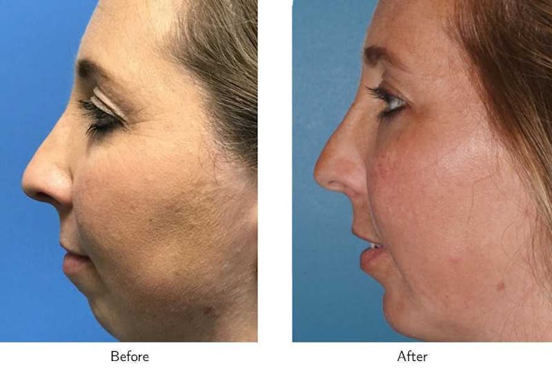 Chin Augmentation Before & After Gallery - Patient 64081170 - Image 1
