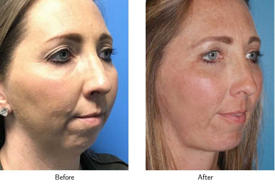 Chin Augmentation Before & After Gallery - Patient 64081170 - Image 2