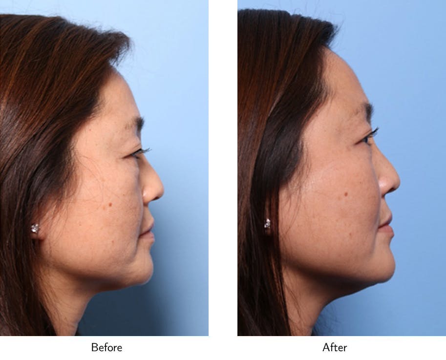 Non-Surgical Facelift Before & After Gallery - Patient 64081172 - Image 2