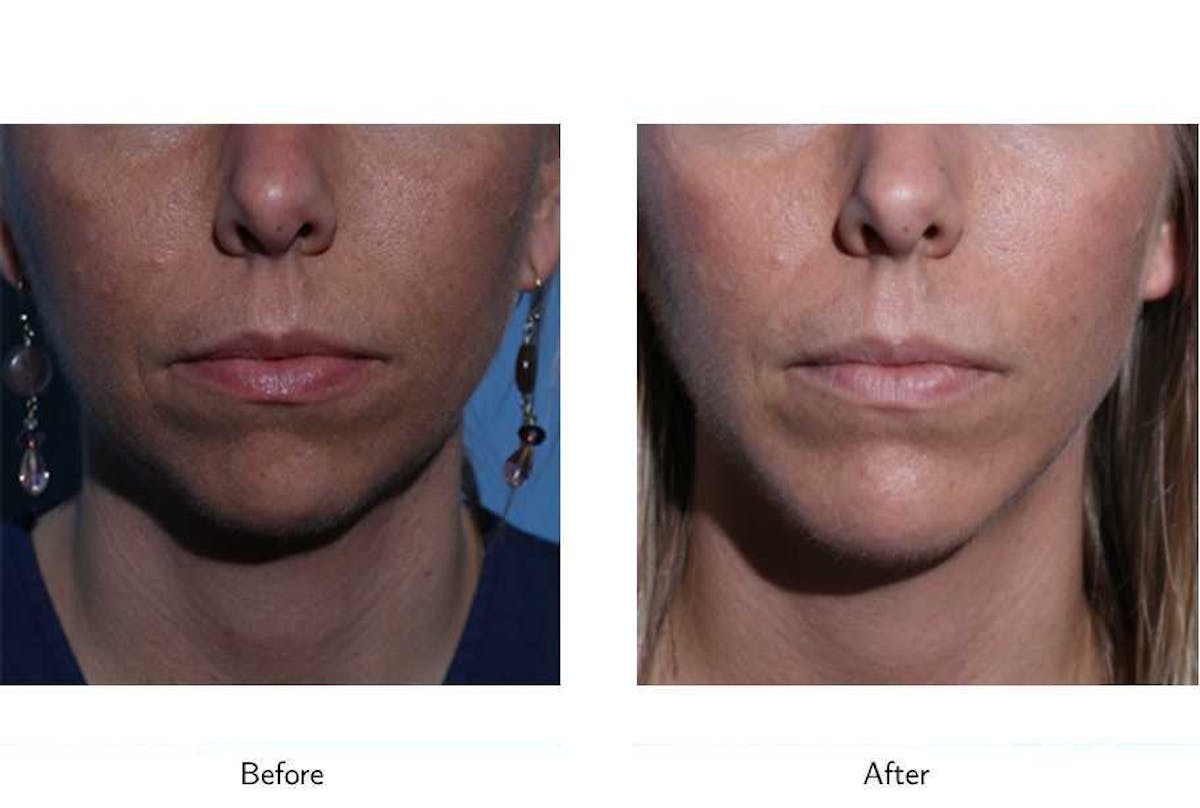 Chin Augmentation Before & After Gallery - Patient 64081171 - Image 1