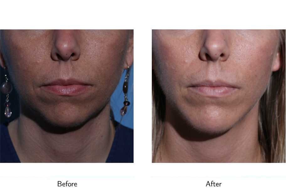Chin Augmentation Before & After Gallery - Patient 64081171 - Image 1