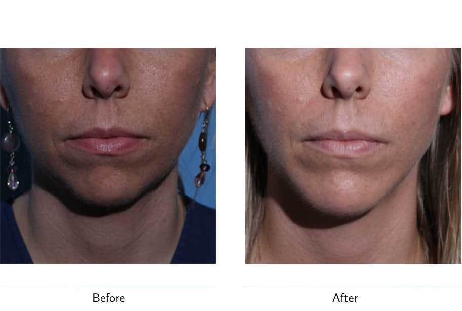 Chin Augmentation Before & After Gallery - Patient 64081171 - Image 1