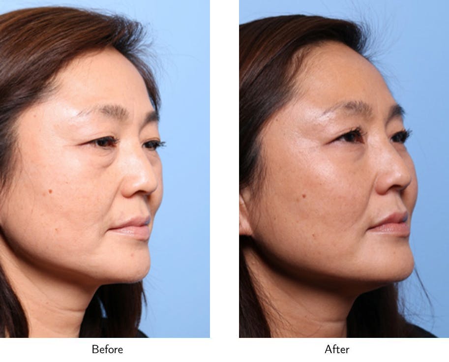Non-Surgical Facelift Before & After Gallery - Patient 64081172 - Image 3