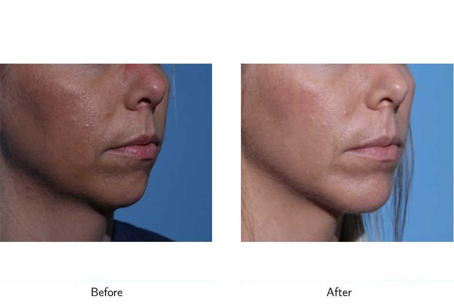 Chin Augmentation Before & After Gallery - Patient 64081171 - Image 2