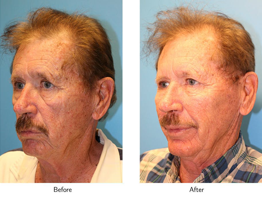 Non-Surgical Facelift Before & After Gallery - Patient 64081176 - Image 2