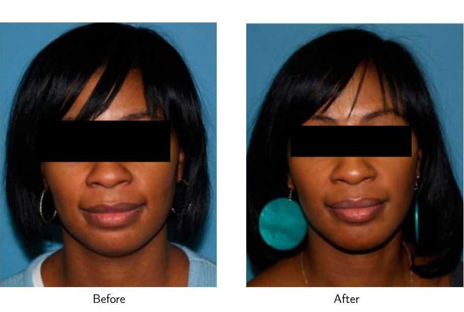 Chin Augmentation Before & After Gallery - Patient 64081173 - Image 1