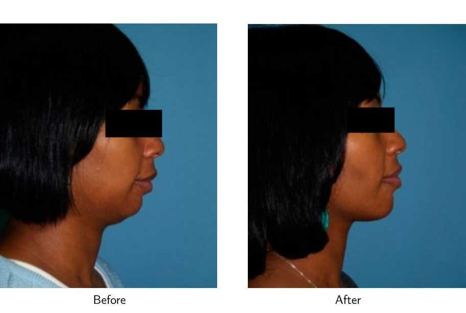 Chin Augmentation Before & After Gallery - Patient 64081173 - Image 2