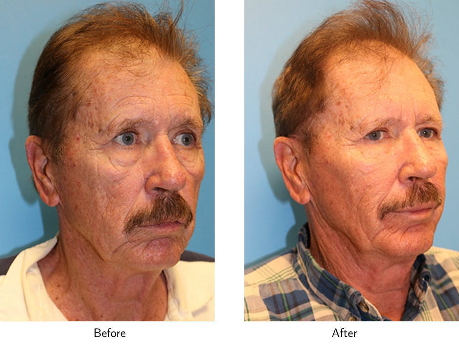 Non-Surgical Facelift Before & After Gallery - Patient 64081176 - Image 3