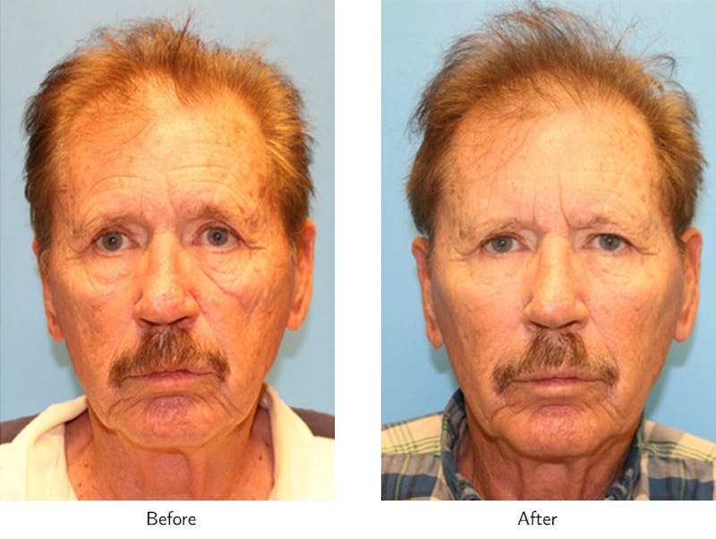 Non-Surgical Facelift Before & After Gallery - Patient 64081176 - Image 1