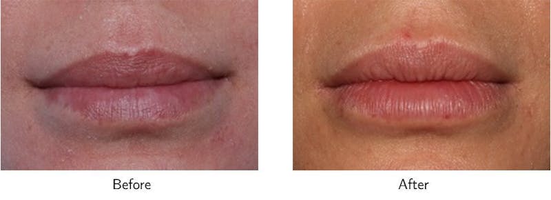 Lip Augmentation Before & After Gallery - Patient 64081178 - Image 1