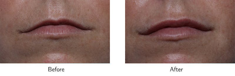 Lip Augmentation Before & After Gallery - Patient 64081179 - Image 1