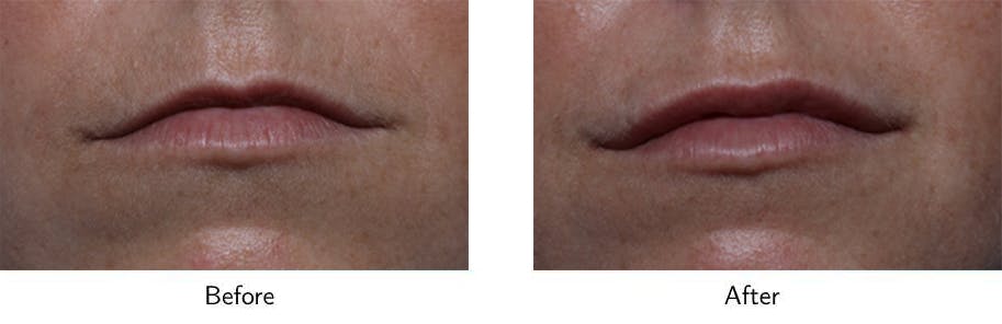 Lip Augmentation Before & After Gallery - Patient 64081179 - Image 1