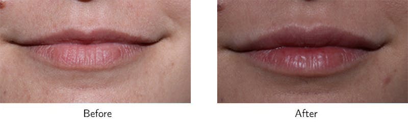 Lip Augmentation Before & After Gallery - Patient 64081180 - Image 1