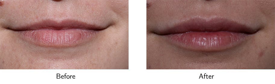Lip Augmentation Before & After Gallery - Patient 64081180 - Image 1