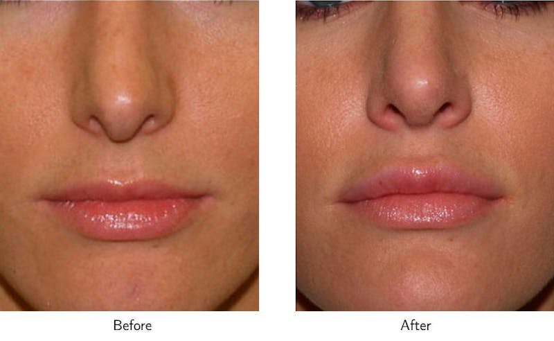 Lip Augmentation Before & After Gallery - Patient 64081181 - Image 1