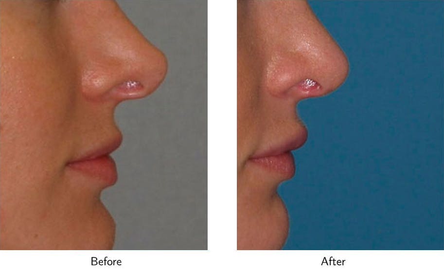 Lip Augmentation Before & After Gallery - Patient 64081181 - Image 2