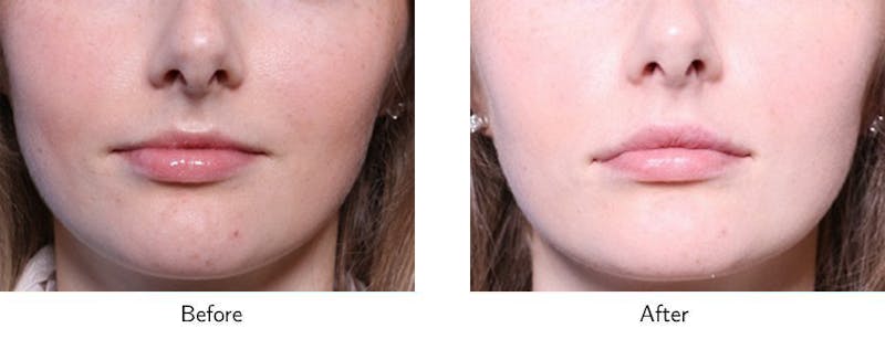 Lip Augmentation Before & After Gallery - Patient 64081182 - Image 1