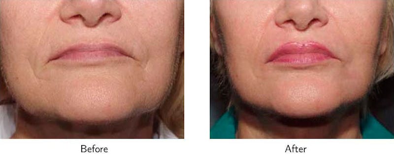 Lip Augmentation Before & After Gallery - Patient 64081185 - Image 1