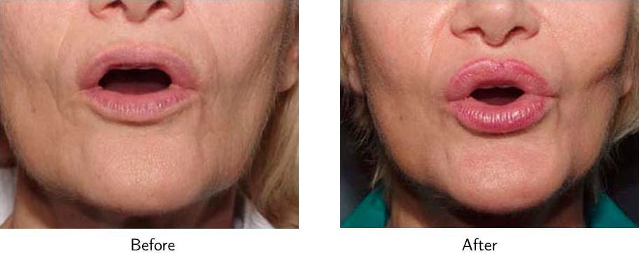 Lip Augmentation Before & After Gallery - Patient 64081185 - Image 2