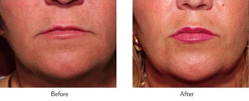 Lip Augmentation Before & After Gallery - Patient 64081186 - Image 1