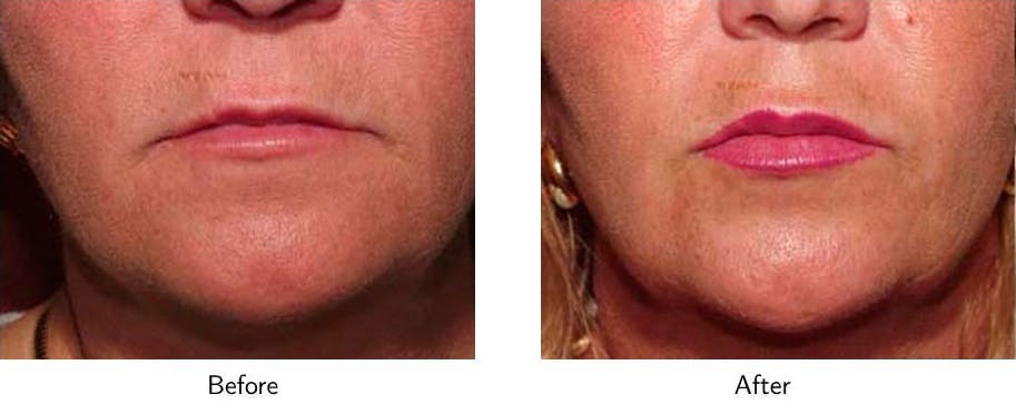 Lip Augmentation Before & After Gallery - Patient 64081186 - Image 1