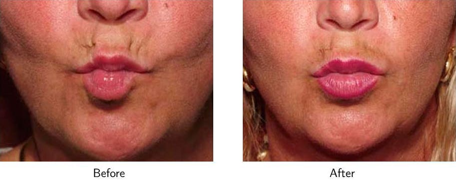 Lip Augmentation Before & After Gallery - Patient 64081186 - Image 2