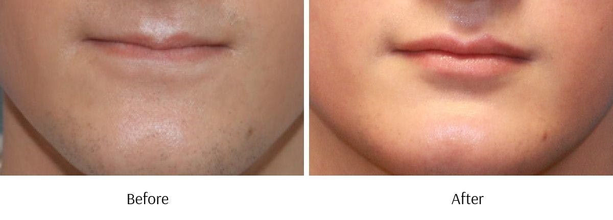 Lip Augmentation Before & After Gallery - Patient 64081187 - Image 1