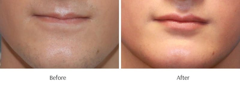 Lip Augmentation Before & After Gallery - Patient 64081187 - Image 1
