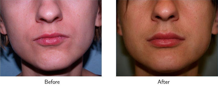 Lip Augmentation Before & After Gallery - Patient 64081188 - Image 1