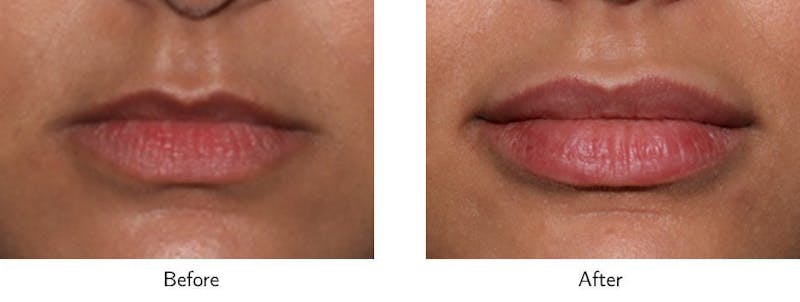 Lip Augmentation Before & After Gallery - Patient 64081189 - Image 1