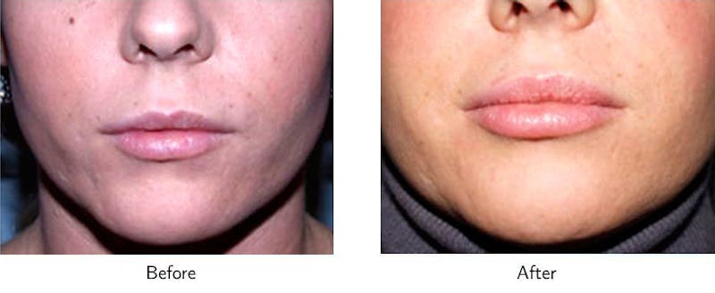 Lip Augmentation Before & After Gallery - Patient 64081190 - Image 1