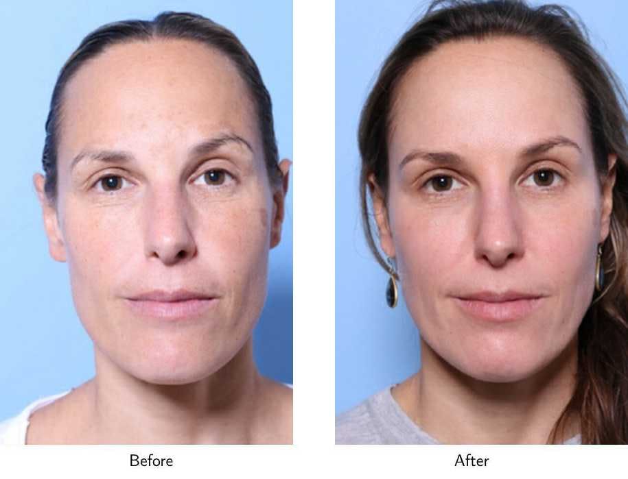 Laser Resurfacing Before & After Gallery - Patient 64081192 - Image 1