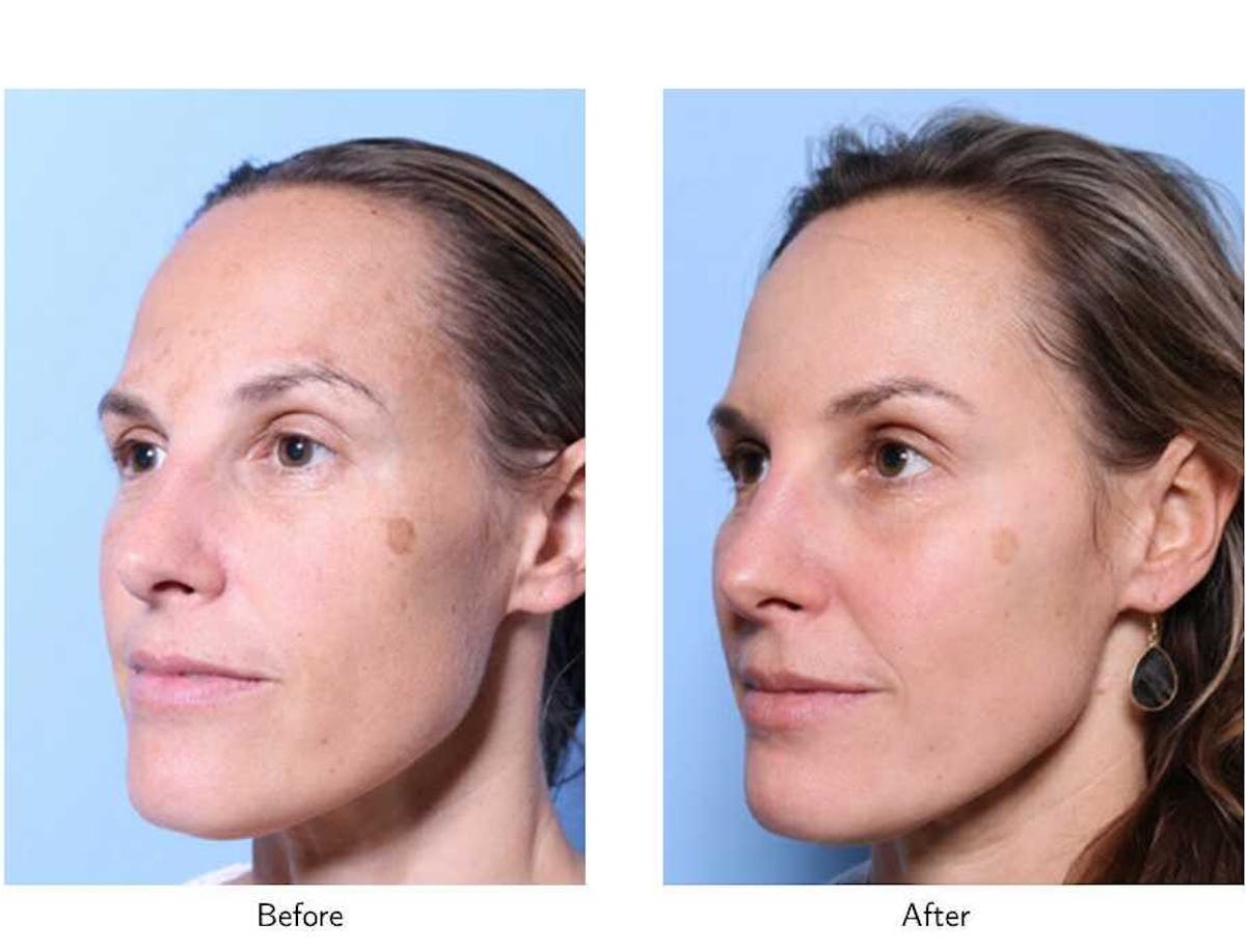Laser Resurfacing Before & After Gallery - Patient 64081192 - Image 3