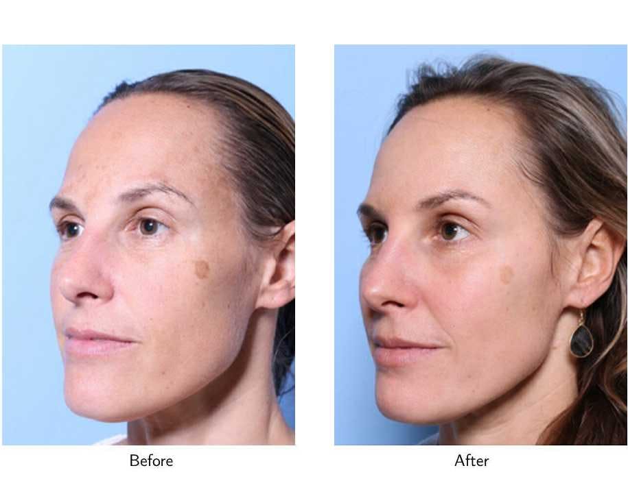 Laser Resurfacing Before & After Gallery - Patient 64081192 - Image 3