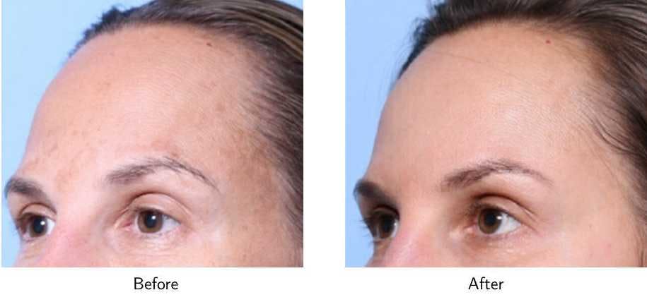 Laser Resurfacing Before & After Gallery - Patient 64081192 - Image 2