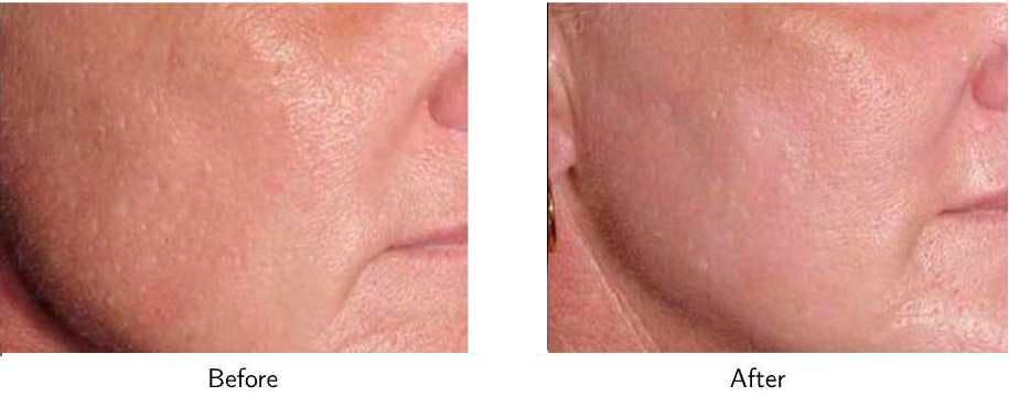 Laser Resurfacing Before & After Gallery - Patient 64081193 - Image 1