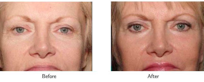 Laser Resurfacing Before & After Gallery - Patient 64081195 - Image 1