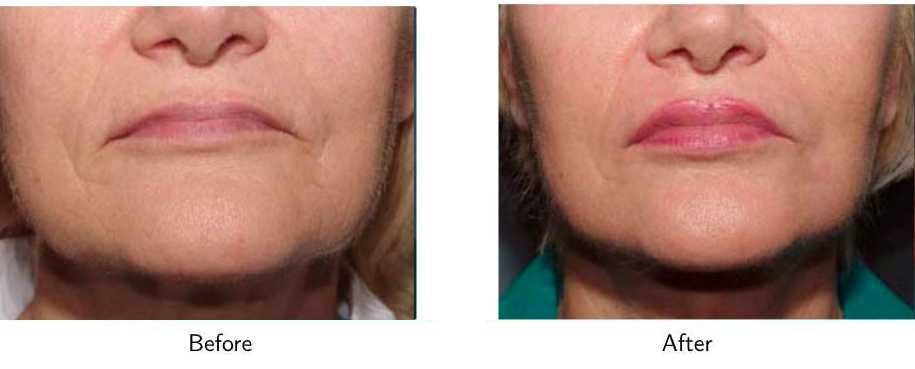 Laser Resurfacing Before & After Gallery - Patient 64081195 - Image 2