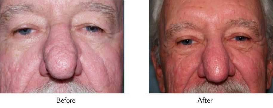 Laser Resurfacing Before & After Gallery - Patient 64081196 - Image 1