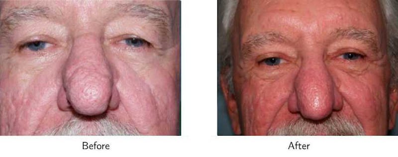 Laser Resurfacing Before & After Gallery - Patient 64081196 - Image 1