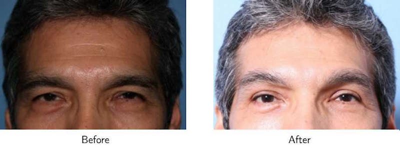 Brow Lift Before & After Gallery - Patient 64081206 - Image 1