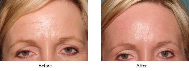 Brow Lift Before & After Gallery - Patient 64081207 - Image 1