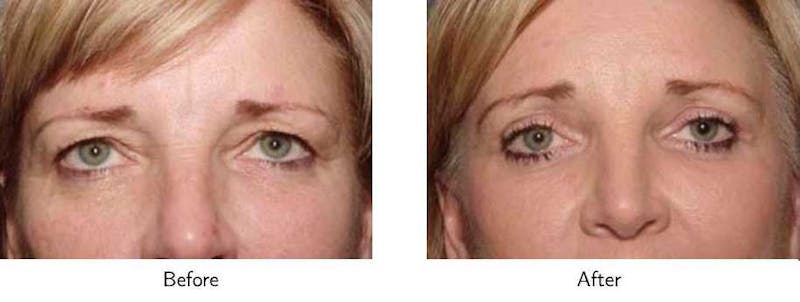 Brow Lift Before & After Gallery - Patient 64081208 - Image 1