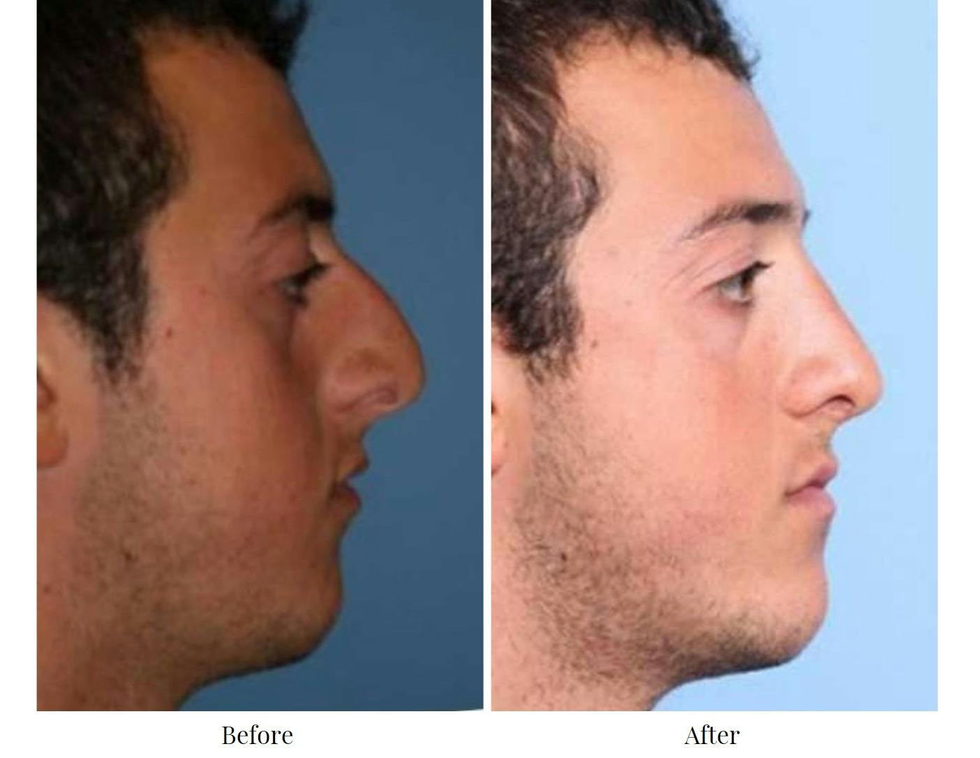 Rhinoplasty Before & After Gallery - Patient 64081086 - Image 1