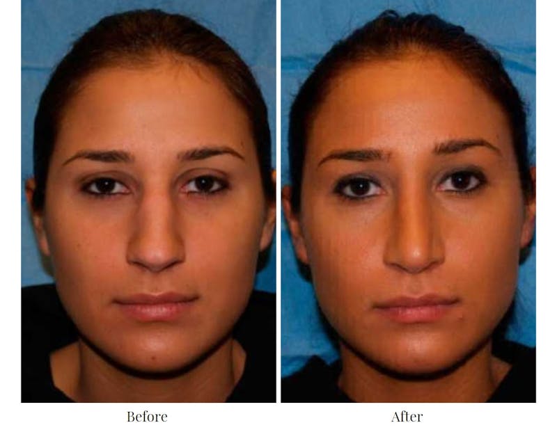 Rhinoplasty Before & After Gallery - Patient 64081076 - Image 1