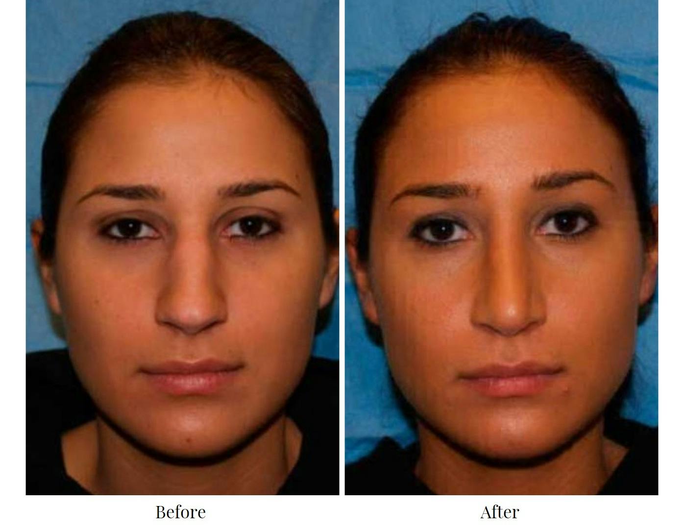 Rhinoplasty Before & After Gallery - Patient 64081076 - Image 1