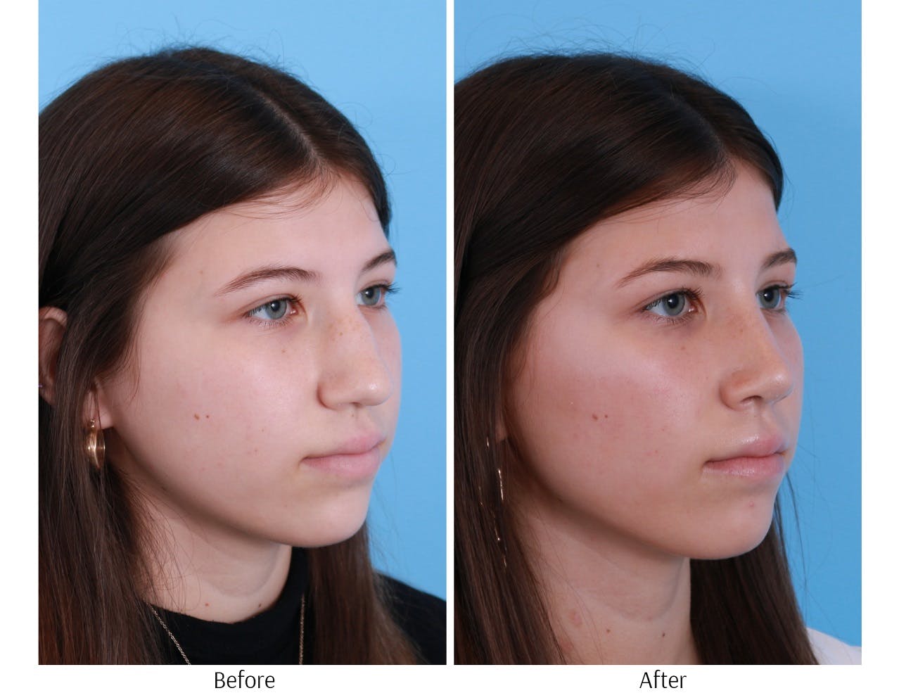 Rhinoplasty Before & After Gallery - Patient 64080948 - Image 4