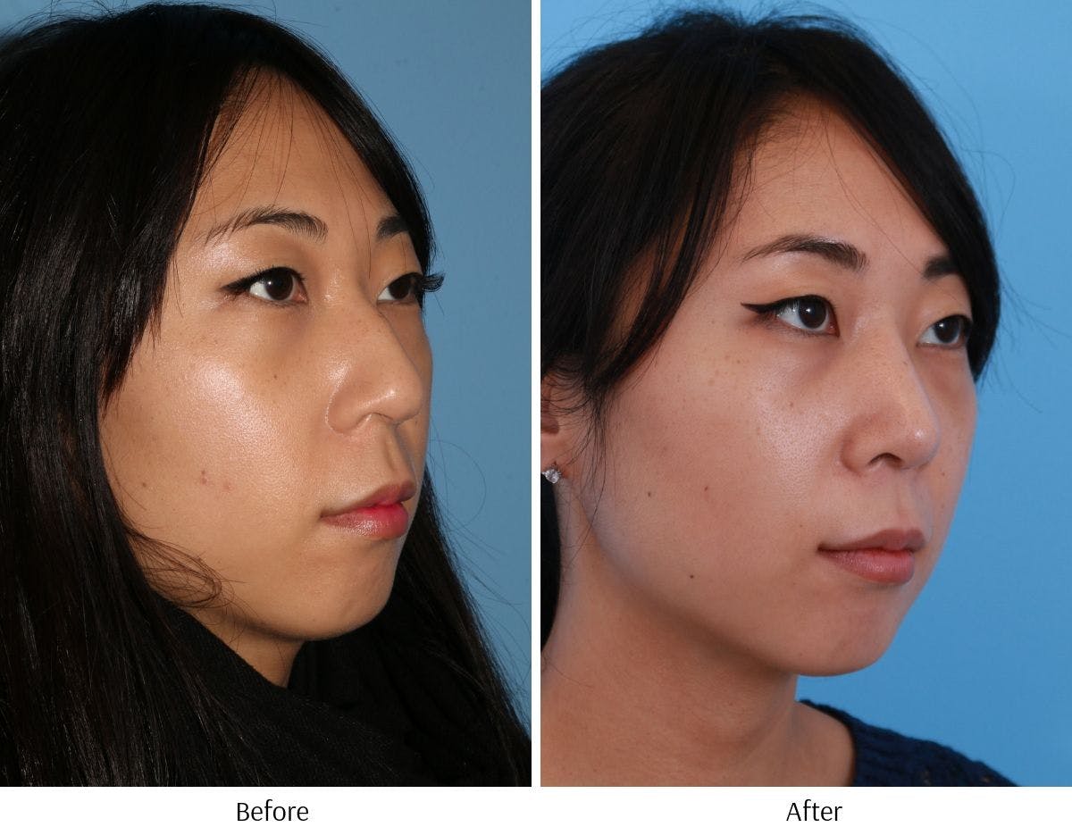 Rhinoplasty Before & After Gallery - Patient 64080953 - Image 4